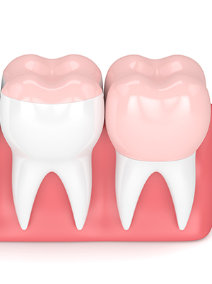 Couronne dentaire – Sourire 2