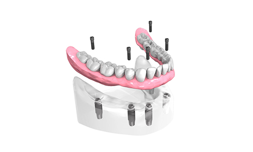 Implantologie dentaire Cannes